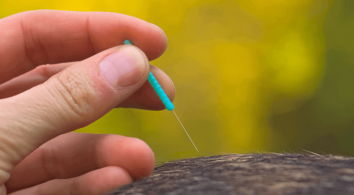 Acupuncture